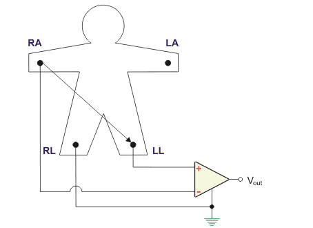 双极肢体导联或标准II型导联